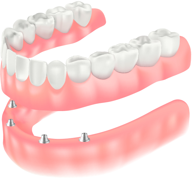 インプラントサポートデンチャー