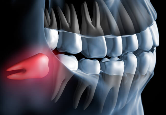 親知らずの抜歯
