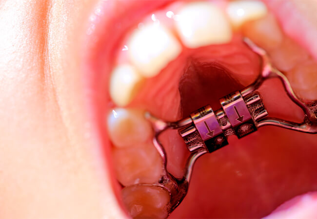 固定式矯正装置