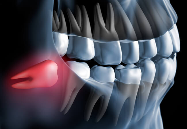 親知らずが痛い・抜くべきか迷っている