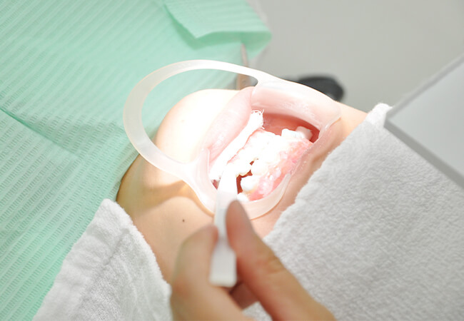 オフィスホワイトニング