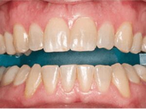 歯の表面をクリーニングした様子