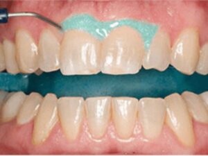 歯肉に薬剤が付着しないようジェルで保護した様子