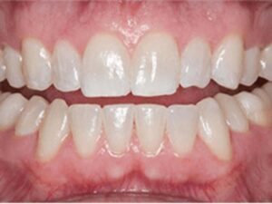 歯肉の保護を取り、口をゆすいだ後の歯